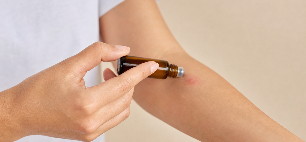 Allergia da puntura di zanzara: riconoscere e calmare con dolcezza